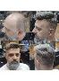 Best Non-surgical Hair Replacement Systems Best Non-surgical Hair Replacement Systems