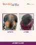 Fue Hair Transplantation in Kondapur