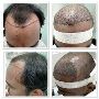 Hair Transplantation in Hitech City