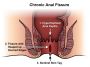 Fissure Treatment in Delhi