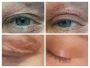 How Much Does Eye Lift Surgery Cost?