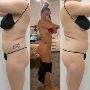 Laser Fat Removal Options, Costs, and Results