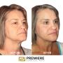 Liposuction Results Before And After