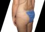 Is the Brazilian Butt Lift Right for You?