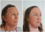 Understanding Brow Lift: A Cosmetic Procedure for a Youthful
