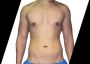 How to Prepare for Vaser Liposuction?