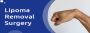 Best Treatment for Lipoma in India | Advanced & Effective 