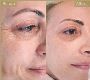 Botox in Dubai : Regain your youthful radiance