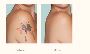 Tattoo Removal at Dr Simple Aher Clinic