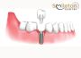 Smileton Dental: Expert Dental Implants in Hyderabad