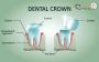 Top Dental Crown Services in Hyderabad – Smileton​