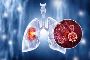 Affordable Lung Cancer Treatment in India