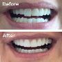 Affordable Composite Bonding St Albans | Book at StPetersLod