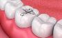 Get Lasting Results with Silver Fillings St Albans