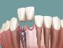 St Albans Missing Teeth Solutions | Long-Lasting Restoration