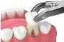 Pain-Free Tooth Extraction in St Albans | Trusted Dentists