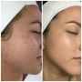 What to expect after green herbal peel?