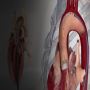 TAVI Interventional Cardiology Mumbai
