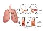 Chronic Obstructive Pulmonary Disease (COPD) Specialist in J
