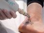 Laser tattoo Removal in Markham | Warriors -ink