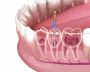 Average Cost of Implants: Pricing and What Influences the 