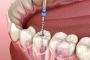 Root Canal Treatment Cost – Pricing, Factors & Affordable Op
