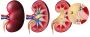 Gallstones vs. Kidney Stones: Everything You Need to Know