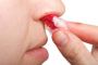 Nosebleeds - Ear, Nose, and Throat Disorders