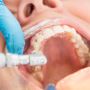 Teeth Cleaning in Flower Mound – Keep Your Smile Fresh & Hea