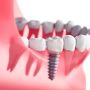 Restore Your Smile with Dental Implants at Active Dental Fri