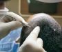 Time To Restore Your Confidence with a Hair Transplant in De