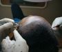 Get Your Hair & Confidence Back – Affordable Hair Transplant