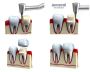 Quality Crown Lengthening in Michigan