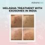 Melasma Treatment with Exosomes in India