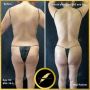 Fat Transfer to Butt–Fuller, Natural Curves in Los Angeles