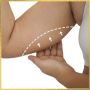 Liposuction Fat Transfer in Los Angeles – Sculpt & Restore N