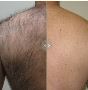 Achieve Silky Smooth Skin with Hair Removal Laser in Cardiff