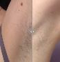 Laser Hair Removal in Cardiff at The Aesthetic Clinic