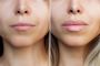 Renew Your Skin with Laser Resurfacing Treatment