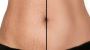 Effective Laser Stretch Mark Removal in Amritsar – Aesthetic