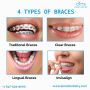 Teeth Whitening Mississauga