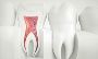 Root Canal Treatment Surrey