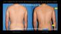 Tummy Tuck For Men Los Angeles – Refine Your Abdomen