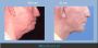 Male Facelift in Los Angeles – Refresh Your Appearance