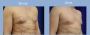 Male Breast Reduction in Los Angeles for a Masculine Chest