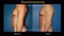 Male Breast Reduction Los Angeles – Sculpt Your Chest