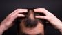 hair transplant services in Islamabad 