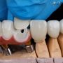 Dental Crowns in Allen, TX - All Smiles Dentistry