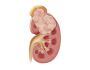 Wilms Tumor Treatment in Pakistan
