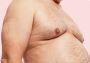 gynecomastia surgery cost in Lahore